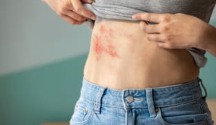 Why shingles hits harder with diabetes