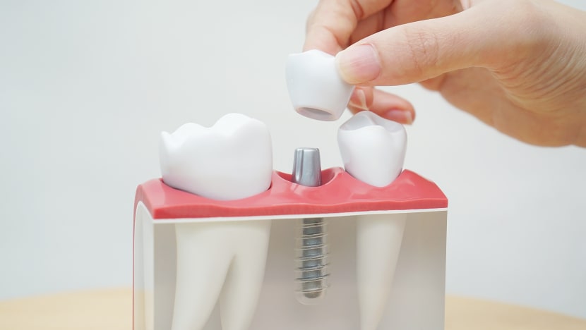 Dental implants costly, but gaining popularity among baby boomers
