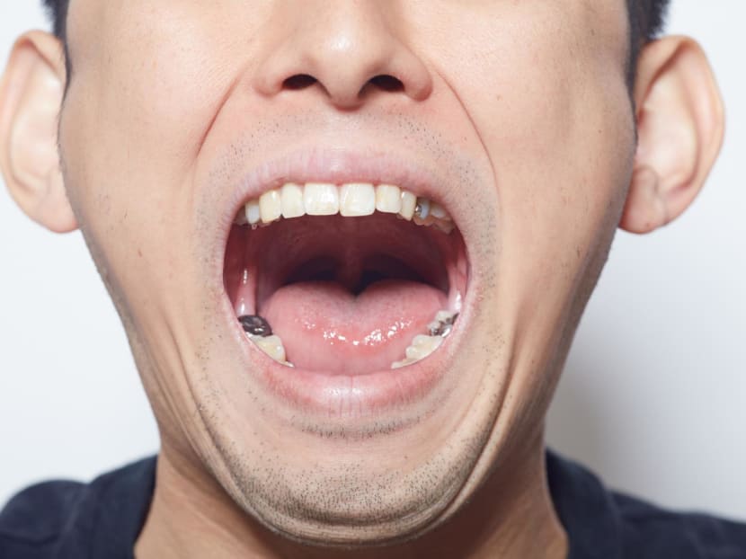 You could start losing teeth in your 30s – how to keep the rest of them before it’s too late You could start losing teeth in your 30s – how to keep the rest of them before it’s too late
