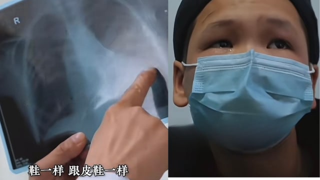 男孩累到提不起书包 送医惊见心脏畸形如“鞋状”