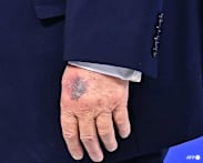 Trump bruised hand on table, he says of new photos