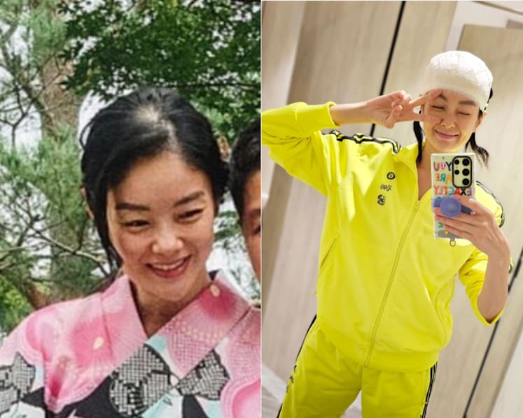 Actress-model Sheila Sim opens up about hair transplant journey to fix ‘prominent bald spot’