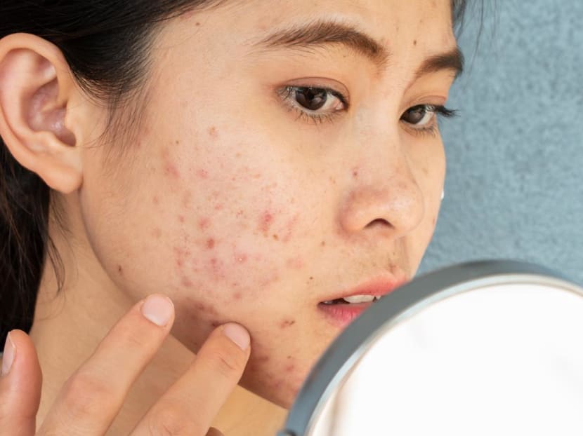 Here’s why misusing acne medications might make your body resistant to antibiotics Here’s why misusing acne medications might make your body resistant to antibiotics