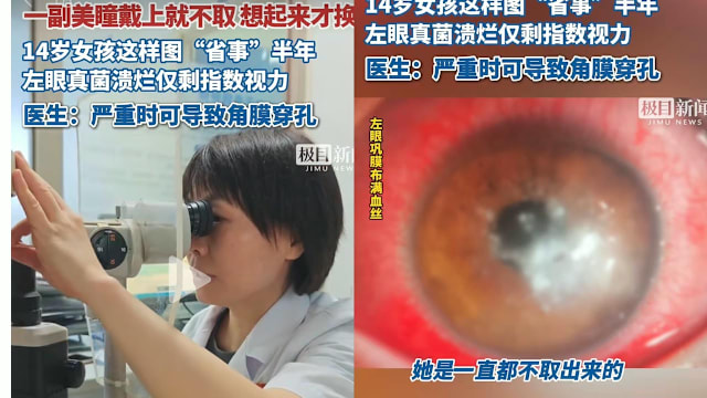长时间佩戴装饰性隐形眼镜 湖北少女左眼溃烂险失明